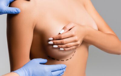 Mastopexia sin prótesis: eleva tu pecho de forma natural, sin necesidad de implantes