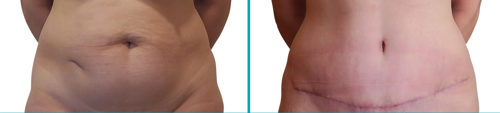 Comparativa del antes y después de una abdominoplastia