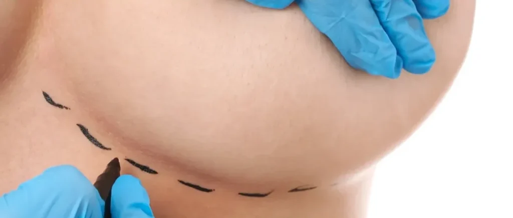 Cicatrices en cirugía plástica: cuidados, ubicación y diferencias entre cicatriz en T y en L 1 ejempl ode cicatrices en cirugia plastica