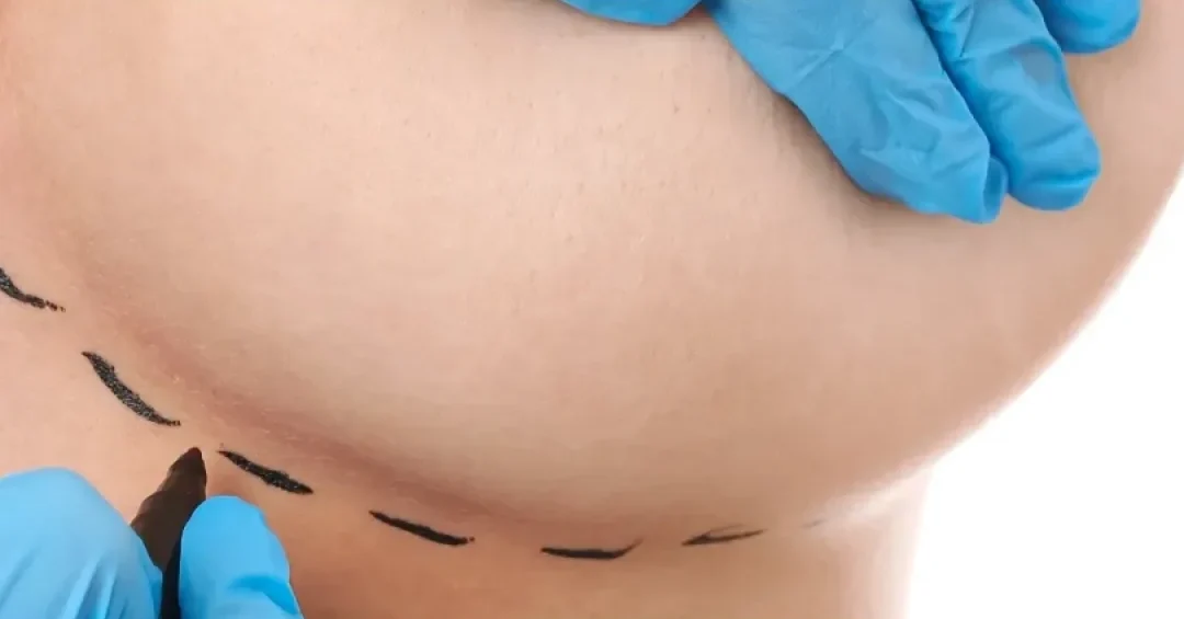 pintando una cicatriz en cirugia plastica