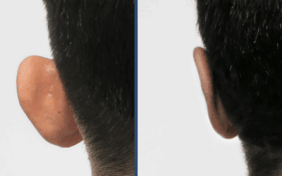 Otoplastia en adultos: resultados naturales, recuperación y qué debes saber