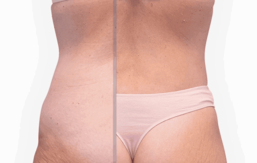 ¿Liposucción, abdominoplastia o lipoabdominoplastia 360º? Qué cirugía necesita cada paciente