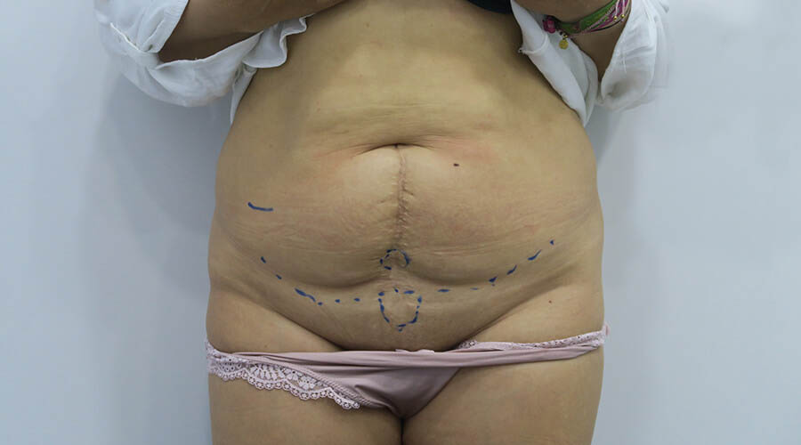 Abdominoplastia en Sevilla | Cirugía plástica, estética y reparadora