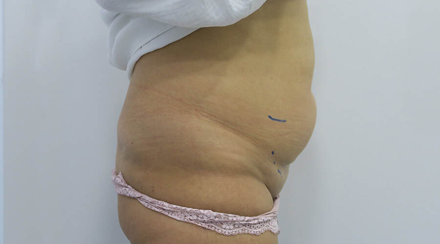 Abdominoplastia en Sevilla | Cirugía plástica, estética y reparadora Abdominoplastia en Sevilla | Cirugía plástica, estética y reparadora
