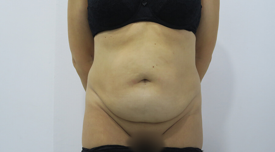Abdominoplastia en Sevilla | Cirugía plástica, estética y reparadora Abdominoplastia en Sevilla | Cirugía plástica, estética y reparadora