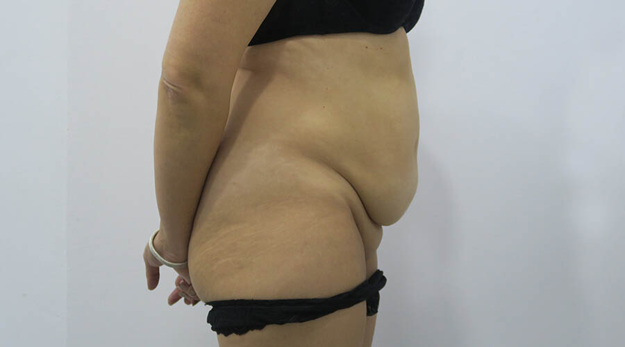 Abdominoplastia en Sevilla | Cirugía plástica, estética y reparadora Abdominoplastia en Sevilla | Cirugía plástica, estética y reparadora