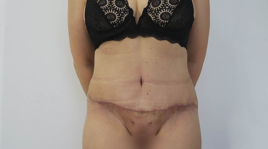 Abdominoplastia en Sevilla | Cirugía plástica, estética y reparadora Abdominoplastia en Sevilla | Cirugía plástica, estética y reparadora