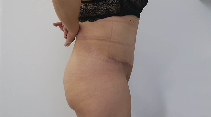 Abdominoplastia en Sevilla | Cirugía plástica, estética y reparadora Abdominoplastia en Sevilla | Cirugía plástica, estética y reparadora