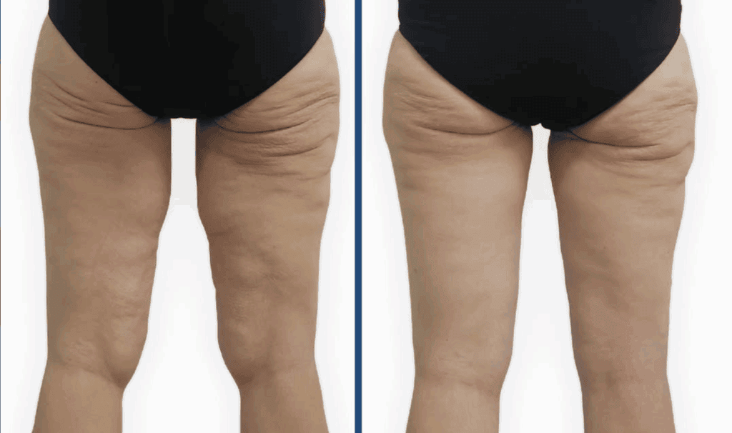 Cruroplastia tras pérdida masiva de peso: cómo mejorar el exceso de piel en los muslos 1 ejemplo antes y despues de una cruroplastia