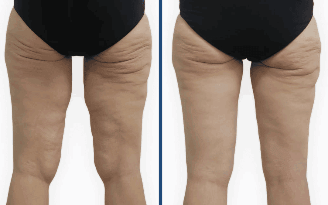 ejemplo antes y despues de una cruroplastia