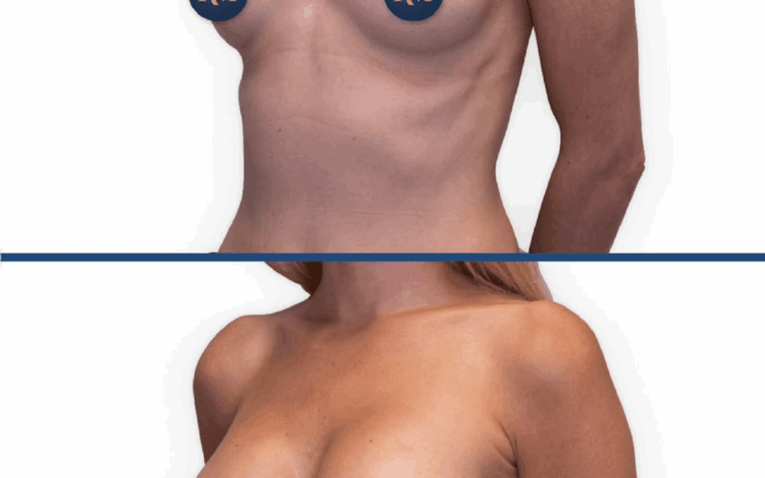 Aumento de pecho personalizado: por qué cada anatomía necesita una cirugía diferente