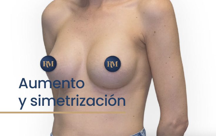 Aumento de pecho y asimetría: cómo conseguir un pecho simétrico con prótesis de diferente volumen