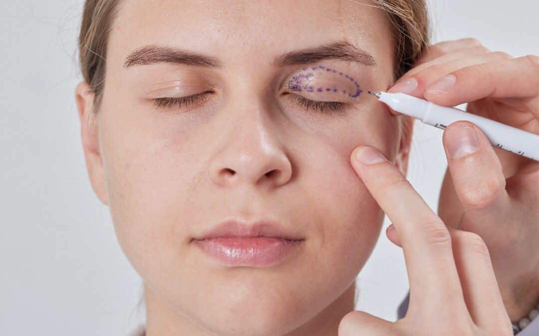 blefaroplastia