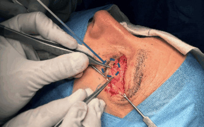 Inicio 14 Blefaroplastia: por qué eliminar piel no siempre es suficiente para conseguir un buen resultado