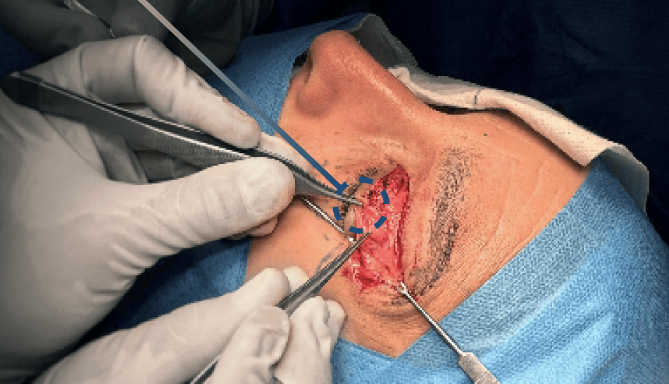 blefaroplastia en acción