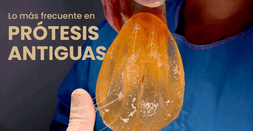 Cambio de prótesis mamarias: cuándo es necesario y qué ha cambiado en los implantes actuales 1 cambio de protesis mamaria antigua en sevilla