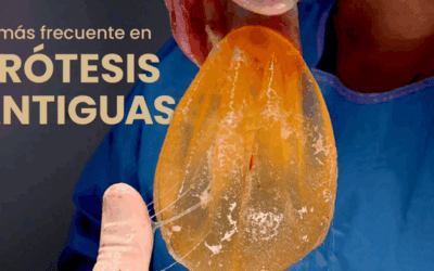 Blog 5 Cambio de prótesis mamarias: cuándo es necesario y qué ha cambiado en los implantes actuales