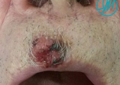 carcinoma escamoso