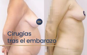 resultado de cirugia combinada tras el embarazo