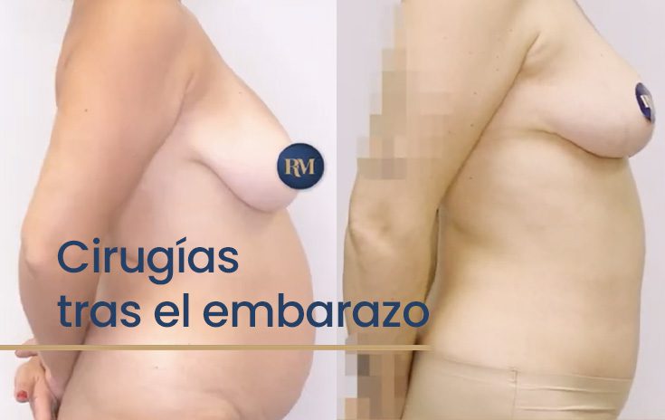 Cambios en el cuerpo después del embarazo: qué se puede mejorar con cirugía