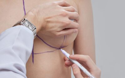 Elevación de pecho sin prótesis: una opción natural para realzar tu figura