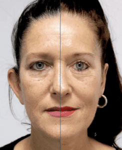 ejemplo de tipos de blefaroplastia