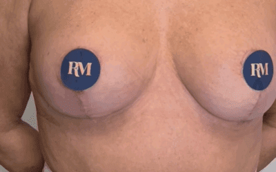 Cicatrices en L: qué son, cuándo se utilizan y cómo evolucionan