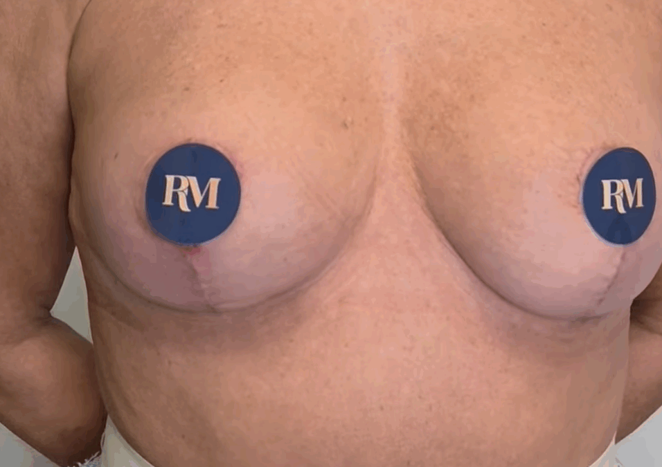 ejemplo de cicatrices en l