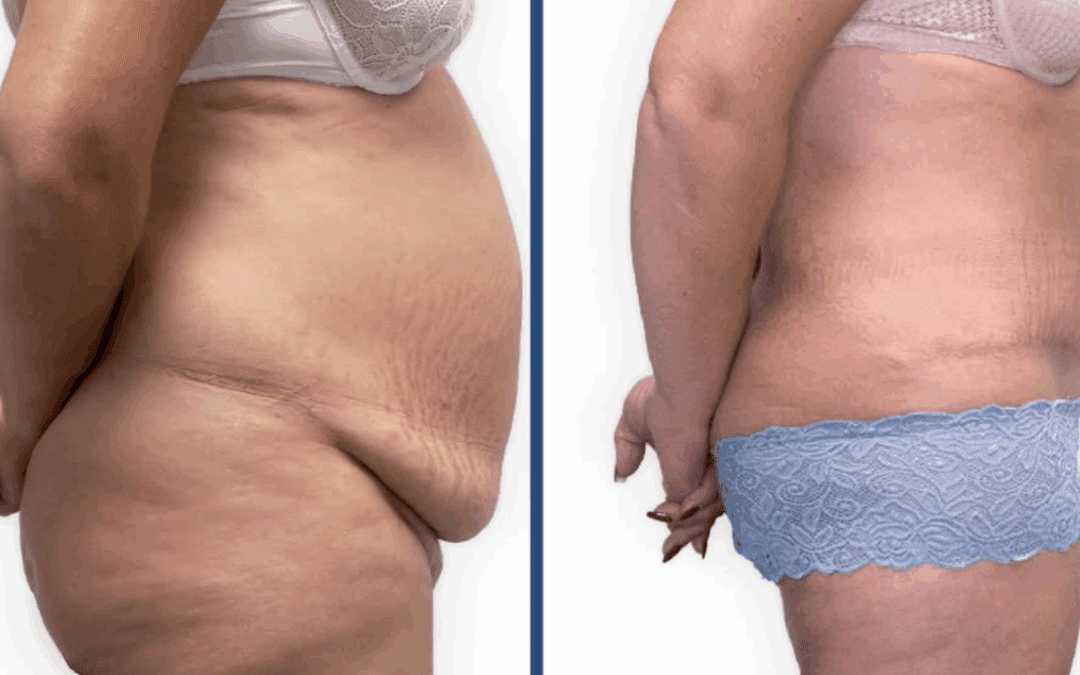 ejemplo de cirugia tras perdida de peso