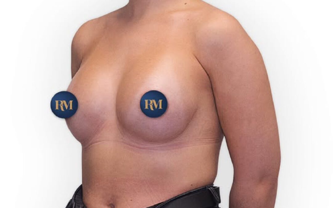 Corrección de mamas tuberosas: cómo se tratan y por qué producen el doble surco