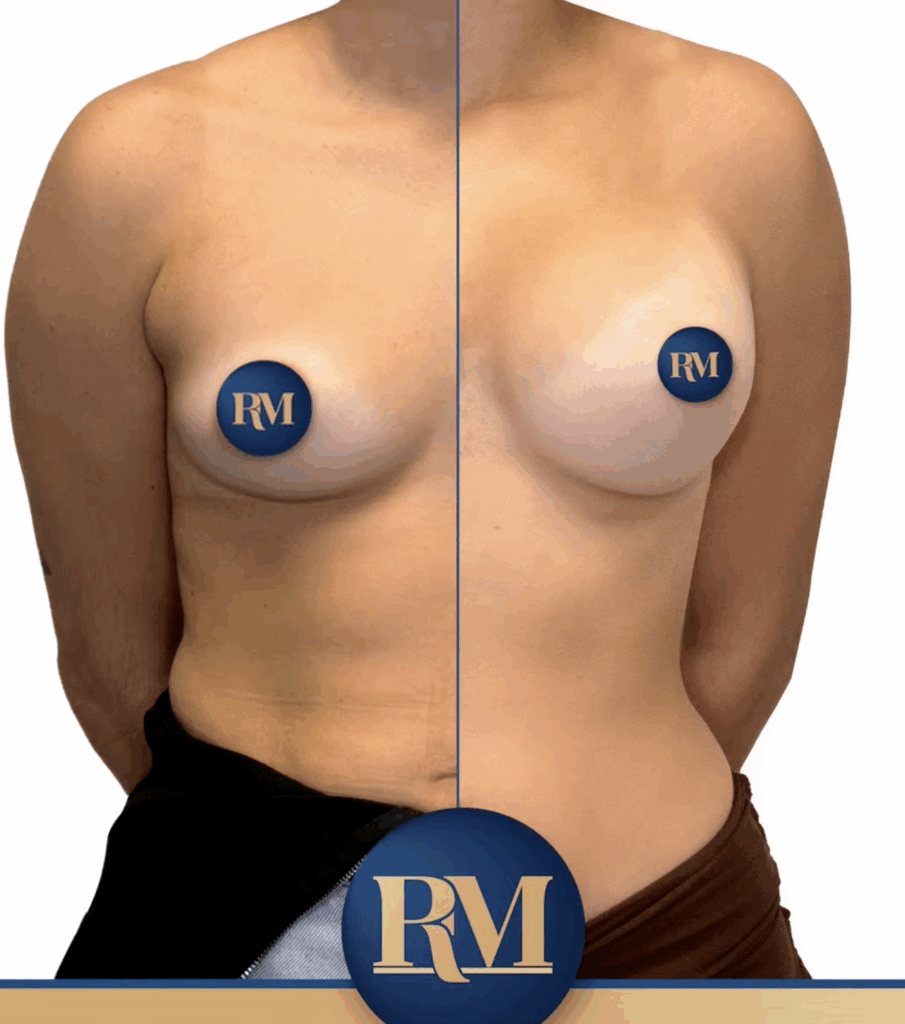 ejemplo de resultado de tipos de mastopexia sin protesis