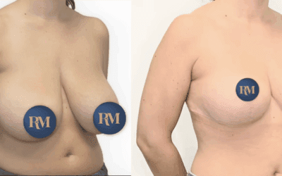 Resultados a largo plazo en cirugía plástica: qué puedes esperar con el paso del tiempo