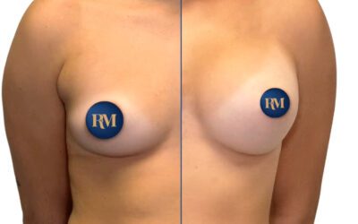 Tipos de mastopexia: con prótesis, sin prótesis y con autoprótesis