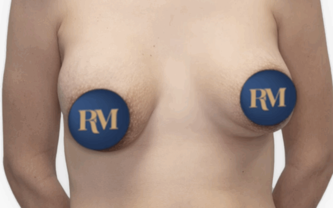 ejemplo de un doble surco mamario en sevilla