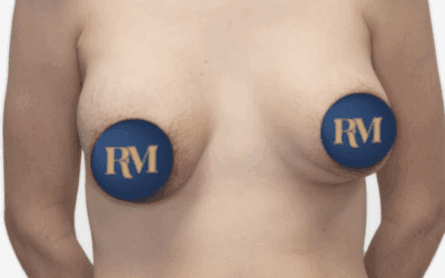 Doble surco en Sevilla: causas, tratamiento y corrección con el Dr. Ruiz Moya