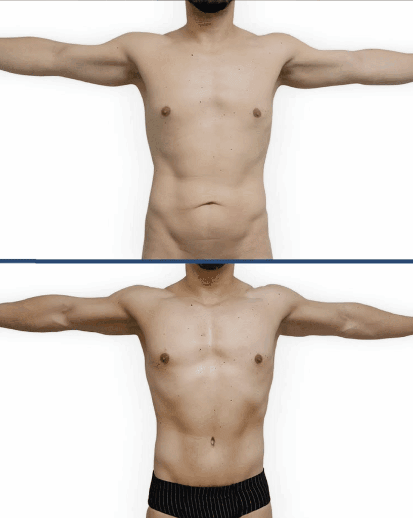 ejemplo de una lipoabdominoplastia en sevilla