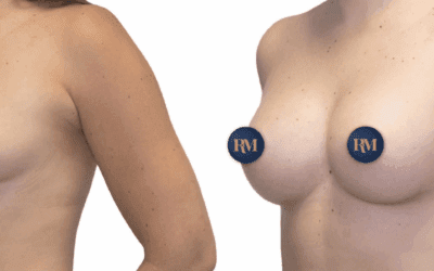 Inicio 14 Aumento de pecho: cómo decidir el volumen ideal entre anatomía y gusto personal