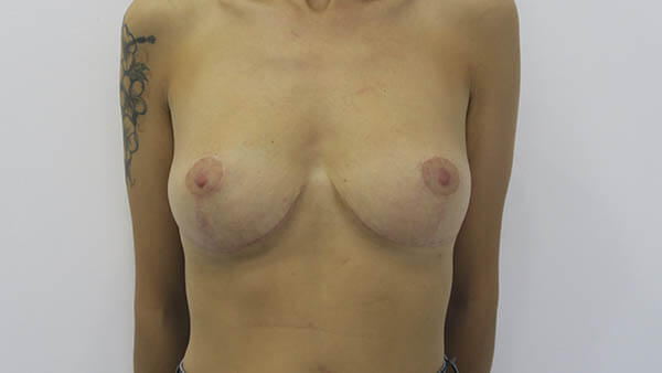 Elevación de mamas en Sevilla | Cirugía plástica, estética y reparadora