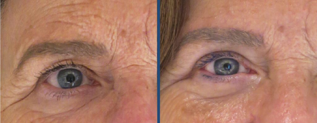 Antes y después de un lifting de cejas realizado por el dr. Alejandro Ruíz Moya