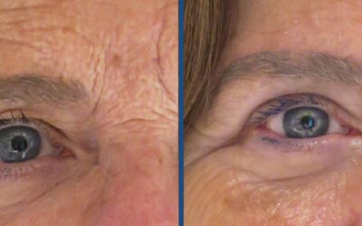 Lifting de Cejas: Rejuvenece tu Mirada con Confianza