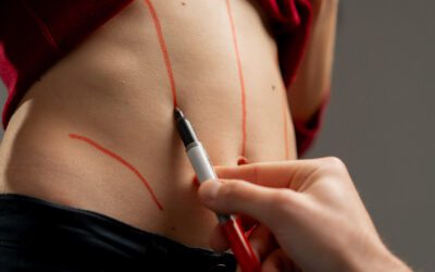 Lipoabdominoplastia postbariátrica: remodela tu cuerpo después de una gran pérdida de peso