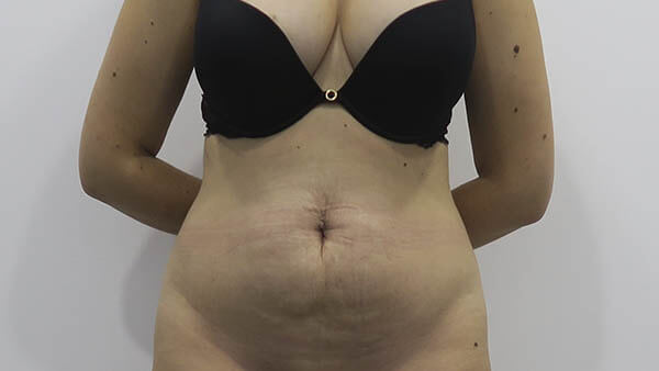 Liposucción en Sevilla | Plástica Ruiz Moya Liposucción en Sevilla | Plástica Ruiz Moya
