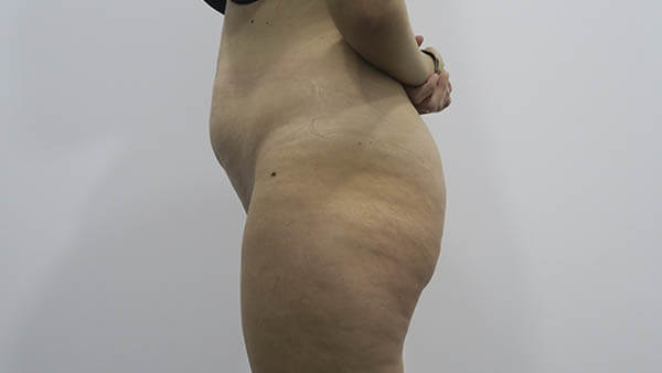 Liposucción en Sevilla | Plástica Ruiz Moya Liposucción en Sevilla | Plástica Ruiz Moya