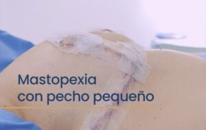 Resultado mastopexia con pecho pequeño