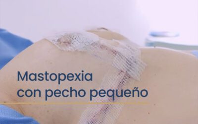 Mastopexia con pecho pequeño: cuando menos volumen es la mejor opción