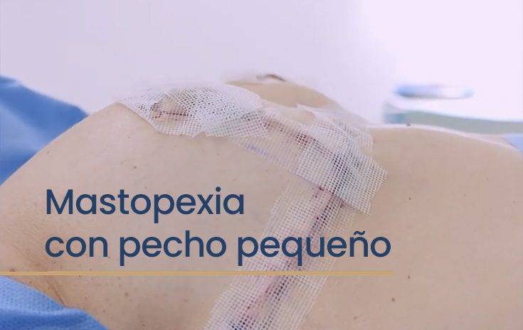 Resultado mastopexia con pecho pequeño
