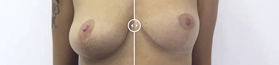 Antes y después de una paciente que se ha sometido a una mastopexia