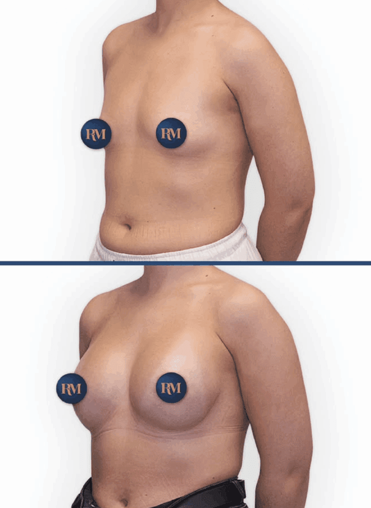 resultado de correccion de mamas tuberosas