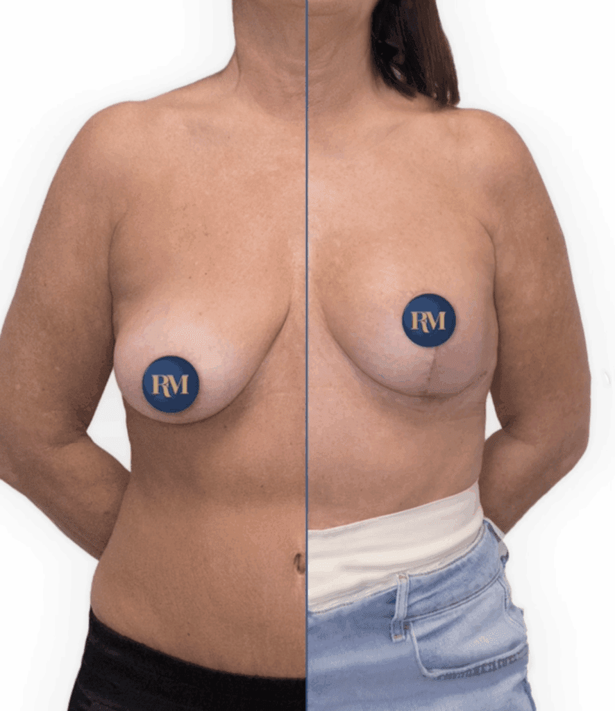 resultado de cicatrices en L