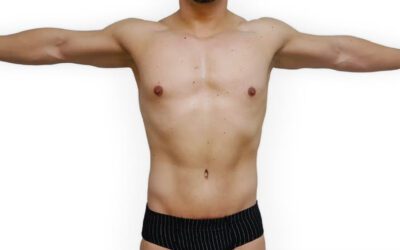 Blog 4 Lipoabdominoplastia en Sevilla: pacientes ideales, cirugía 360 y recuperación completa